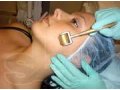 Мезороллерная терапия - сотри морщинки с лица! (без инъекций) в городе Курск, фото 1, Курская область