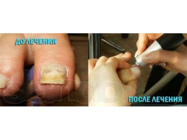 Обработка, лечение вросшего ногтя в городе Новосибирск, фото 1, стоимость: 0 руб.