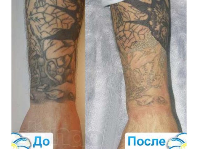 Лазерное удаление (сведение) татуировок в городе Астрахань, фото 1, Другое
