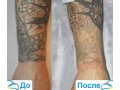 Лазерное удаление (сведение) татуировок в городе Астрахань, фото 1, Астраханская область