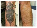 Лазерное удаление (сведение) татуировок в городе Астрахань, фото 3, Другое