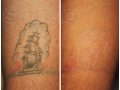 Лазерное удаление (сведение) татуировок в городе Астрахань, фото 4, Астраханская область