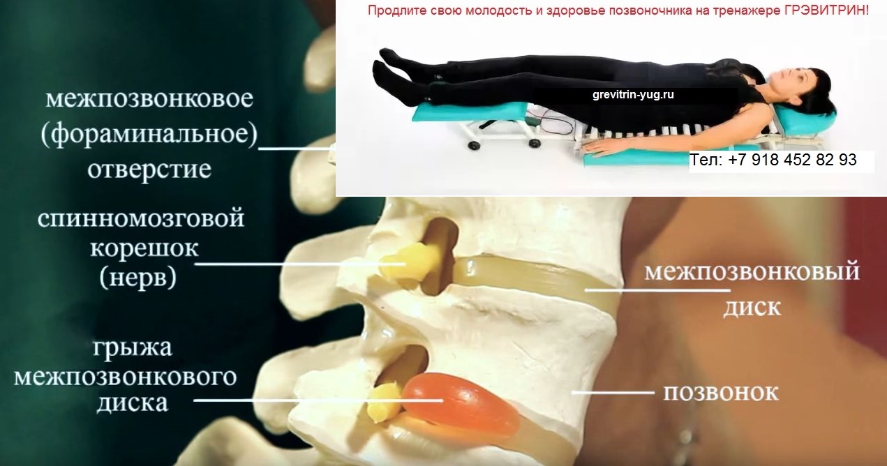 Лечение компрессионного перелома позвоночника цена тренажер Грэвитрин в городе Казань, фото 4, телефон продавца: +7 (918) 452-82-93